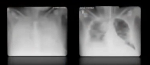 X-rays of Smith's lungs before and after treatment.  In the before x-ray, the lungs are completely whited out, in the after, substantial parts of the lungs are clear.