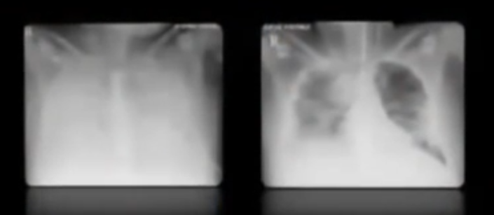 X-rays of Smith's lungs before and after treatment.  In the before x-ray, the lungs are completely whited out, in the after, substantial parts of the lungs are clear.